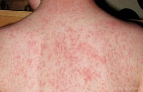 سرخکان؛ تهدید جدی برای کودکان، افغانستان در سایه افزایش موارد ابتلا