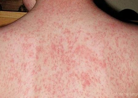 سرخکان؛ تهدید جدی برای کودکان، افغانستان در سایه افزایش موارد ابتلا