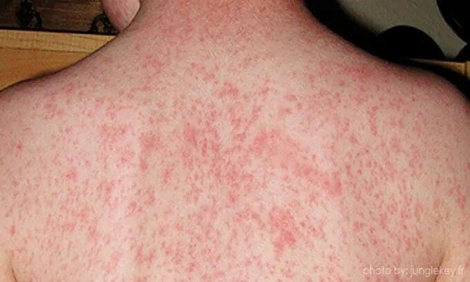 سرخکان؛ تهدید جدی برای کودکان، افغانستان در سایه افزایش موارد ابتلا