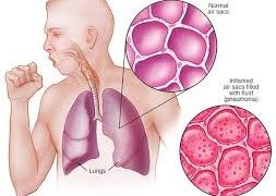 تشدید بیماری‌ های تنفسی در میان کودکان با فرارسیدن فصل زمستان