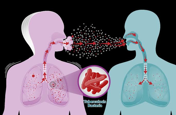 بررسی همه گیری سل (توبرکلوزیس) در افغانستان: چالش ها و ابعاد انسانی